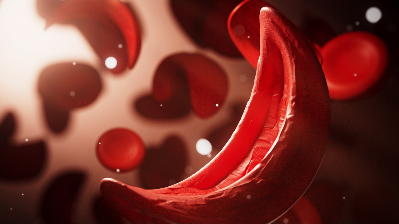 sickle-cell-disease-1280