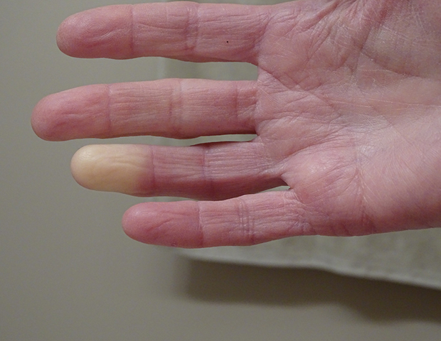 raynauds summary.jpg