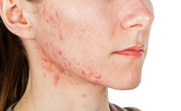 Acne 620.jpg