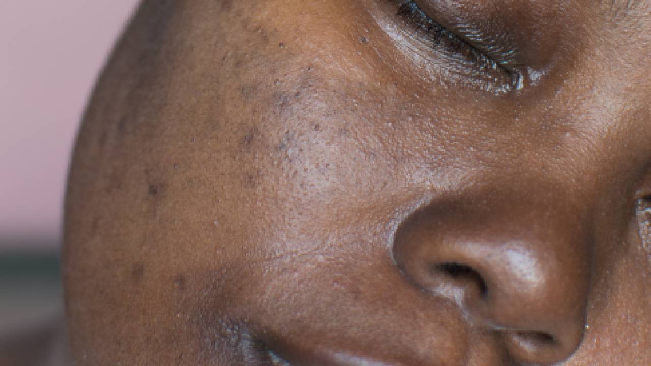 hyperpigmentation-in-darker-skin-summary